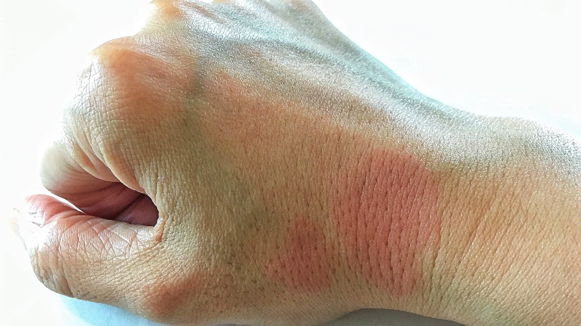 lupus skin symptoms