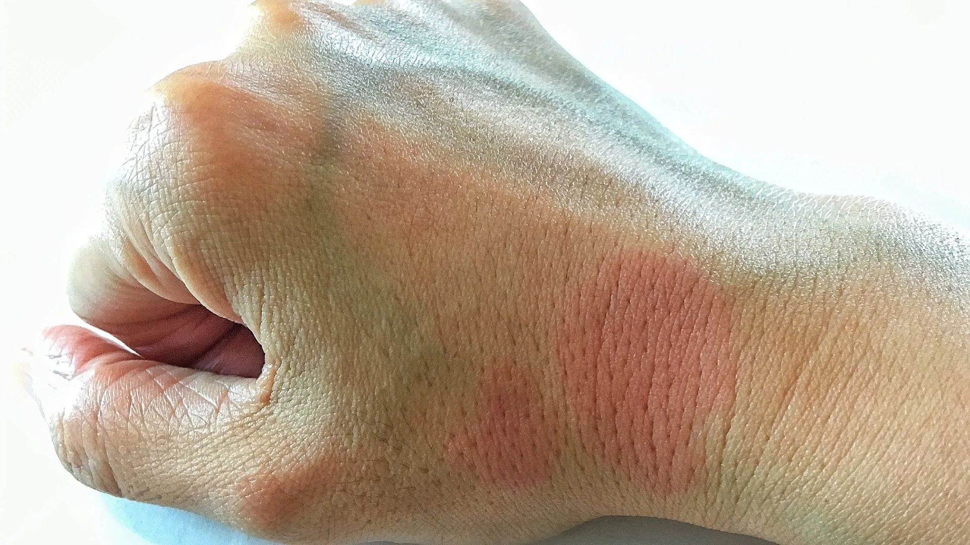 lupus skin symptoms