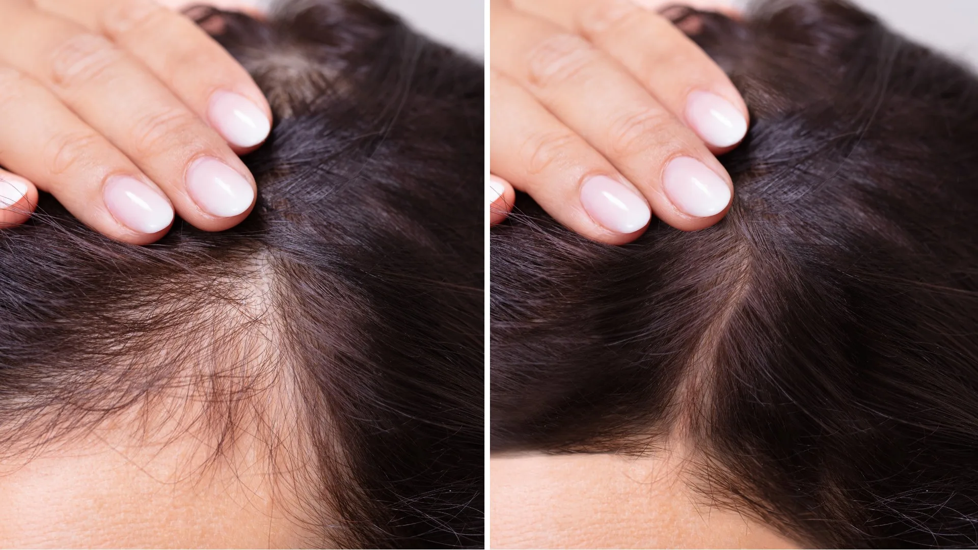 Does-low-dopamine-cause-hair-loss