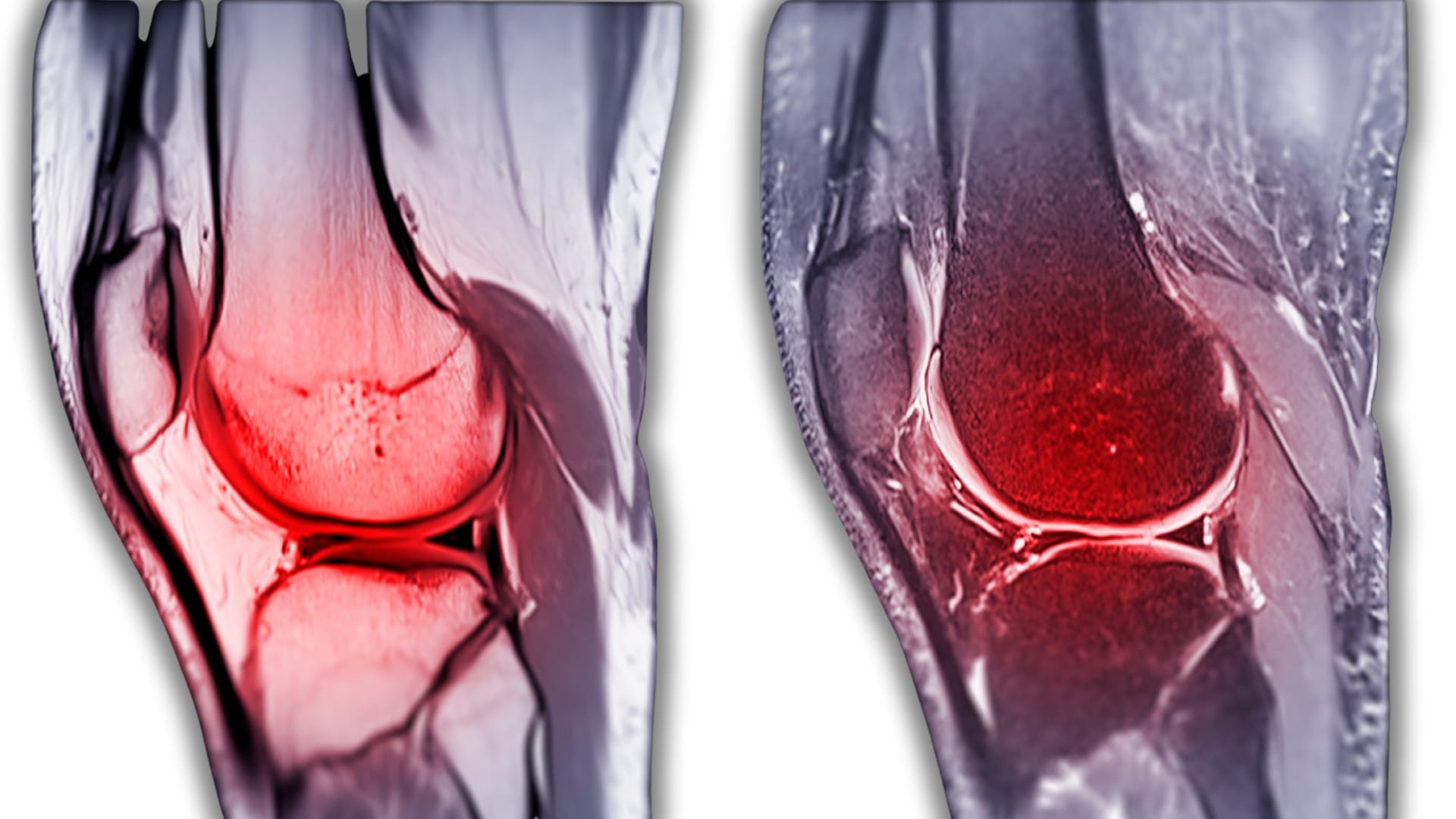 ACL tear image