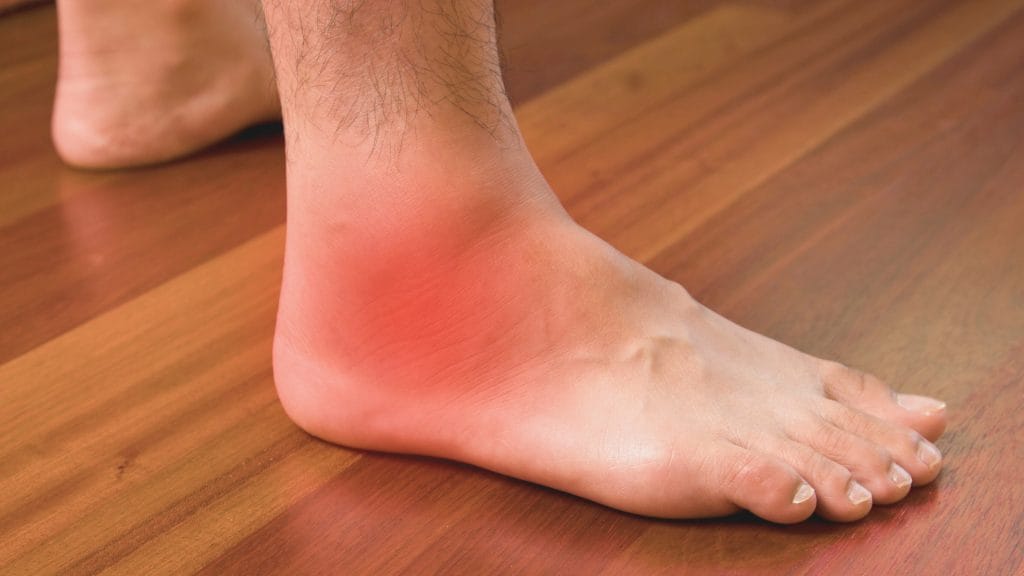 How to Heal an Acute Ankle Sprain Faster