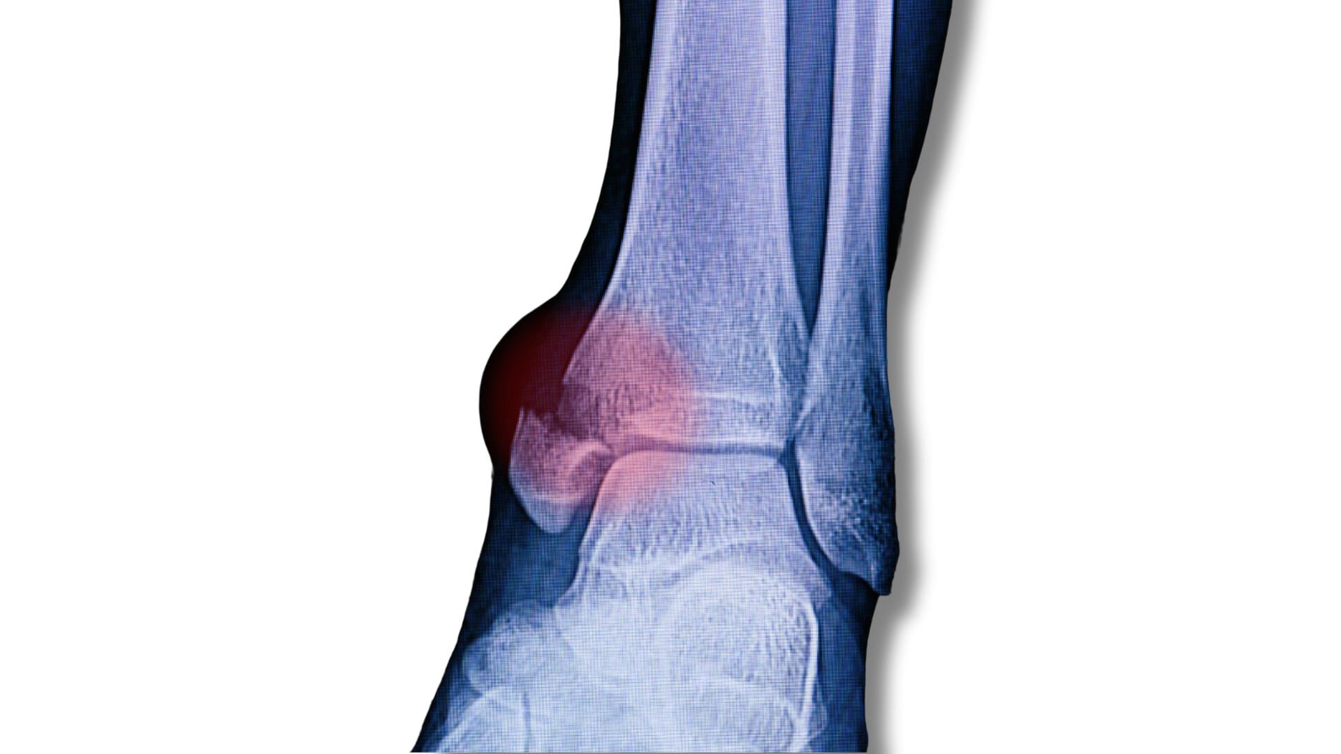 Ligament Strain