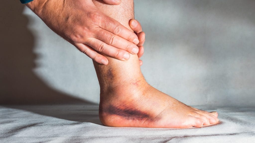 Medial Ankle Instability