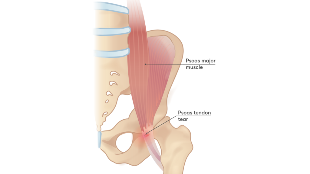 ANF Therapy psoas muscles hip pain