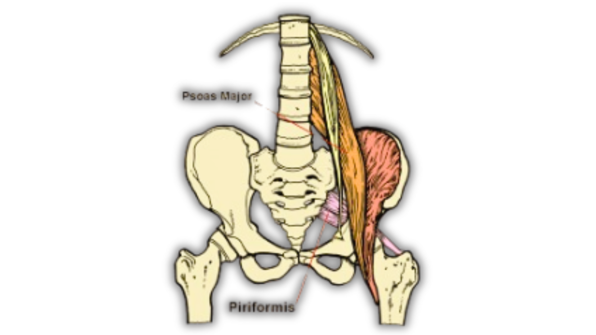 Psoas–Piriformis Syndrome