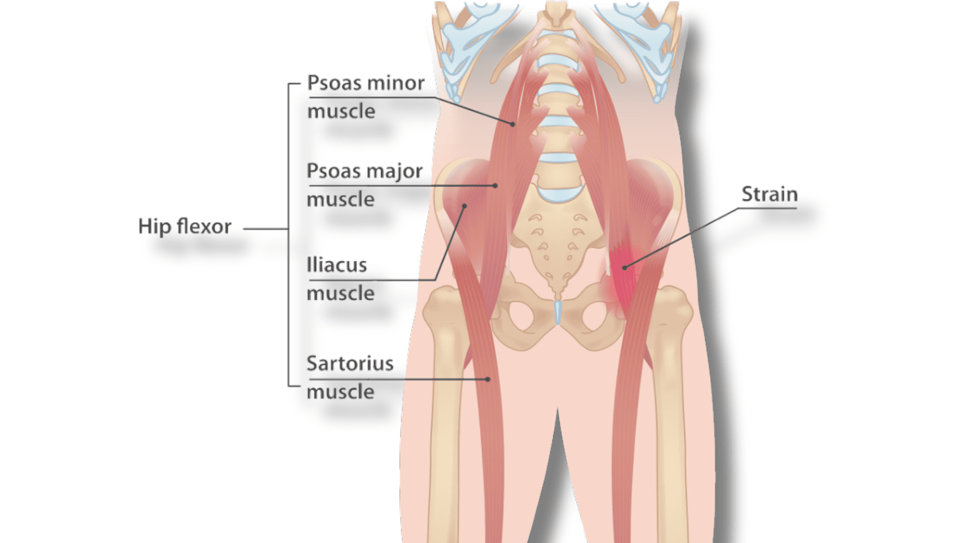 Psoas Tendinitis