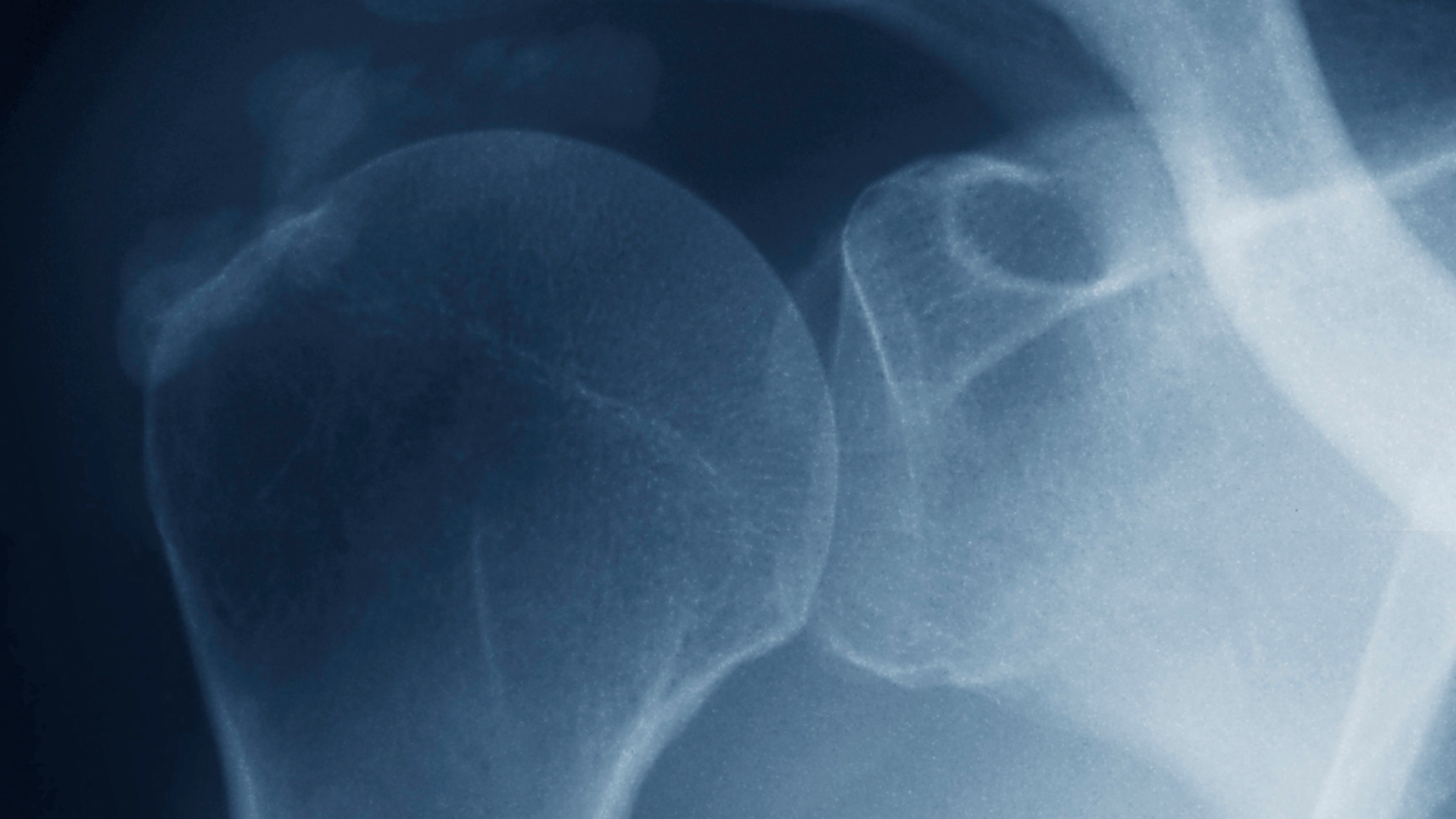 Understanding Calcific Tendinitis