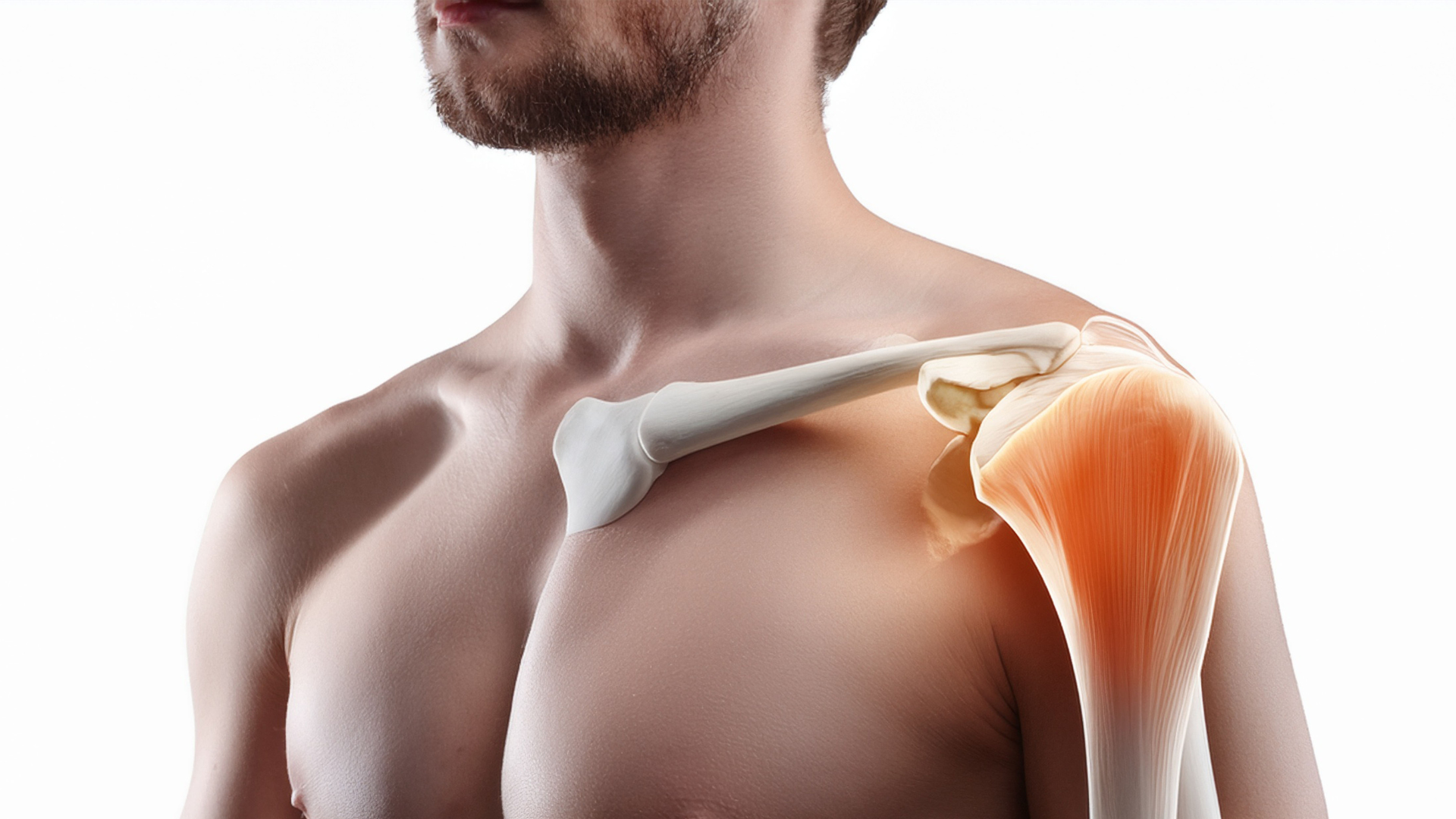 What causes calcific tendinitis of the shoulder joint