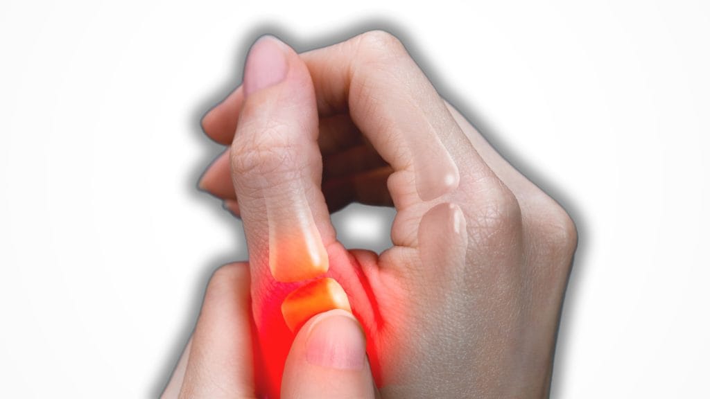 Thumb Ulnar Collateral Ligament Injury