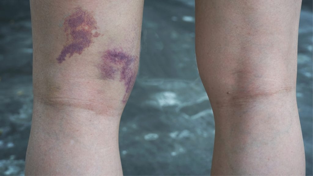 Hamstring Injury Cause Bruising