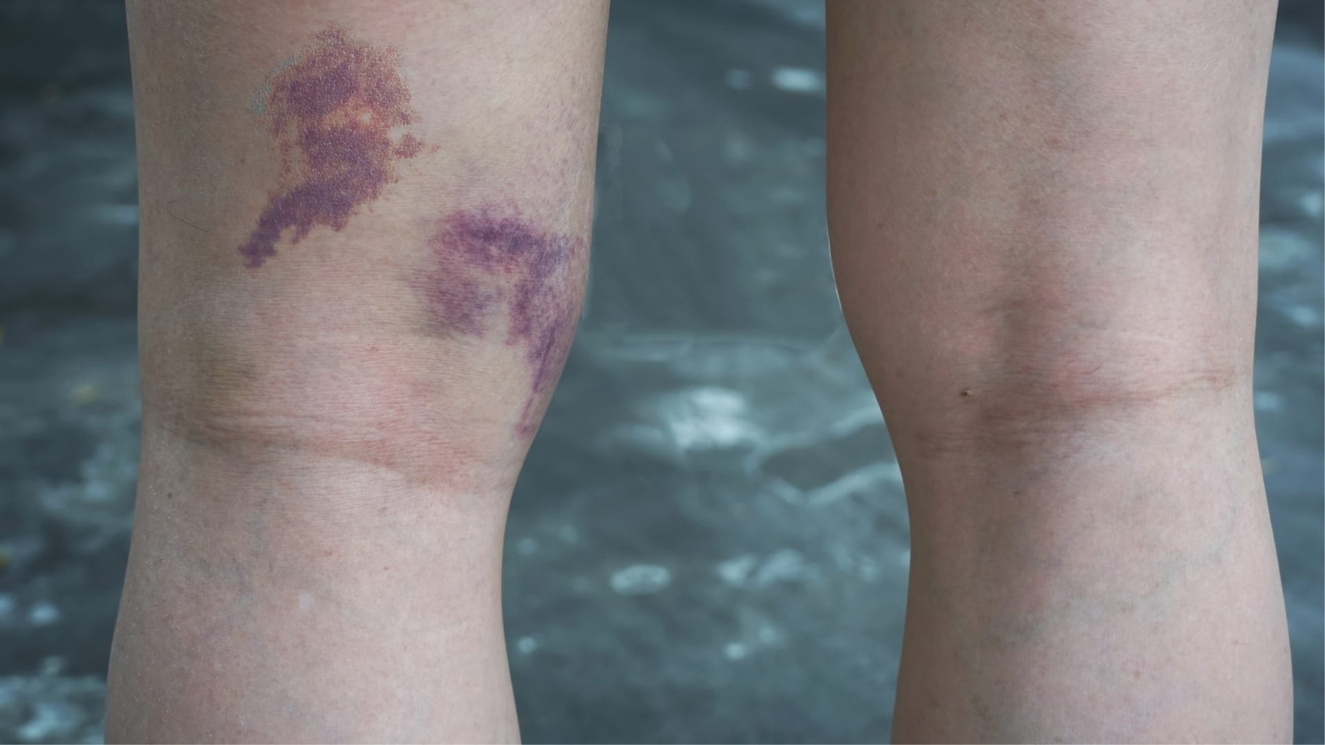 Hamstring Injury Cause Bruising