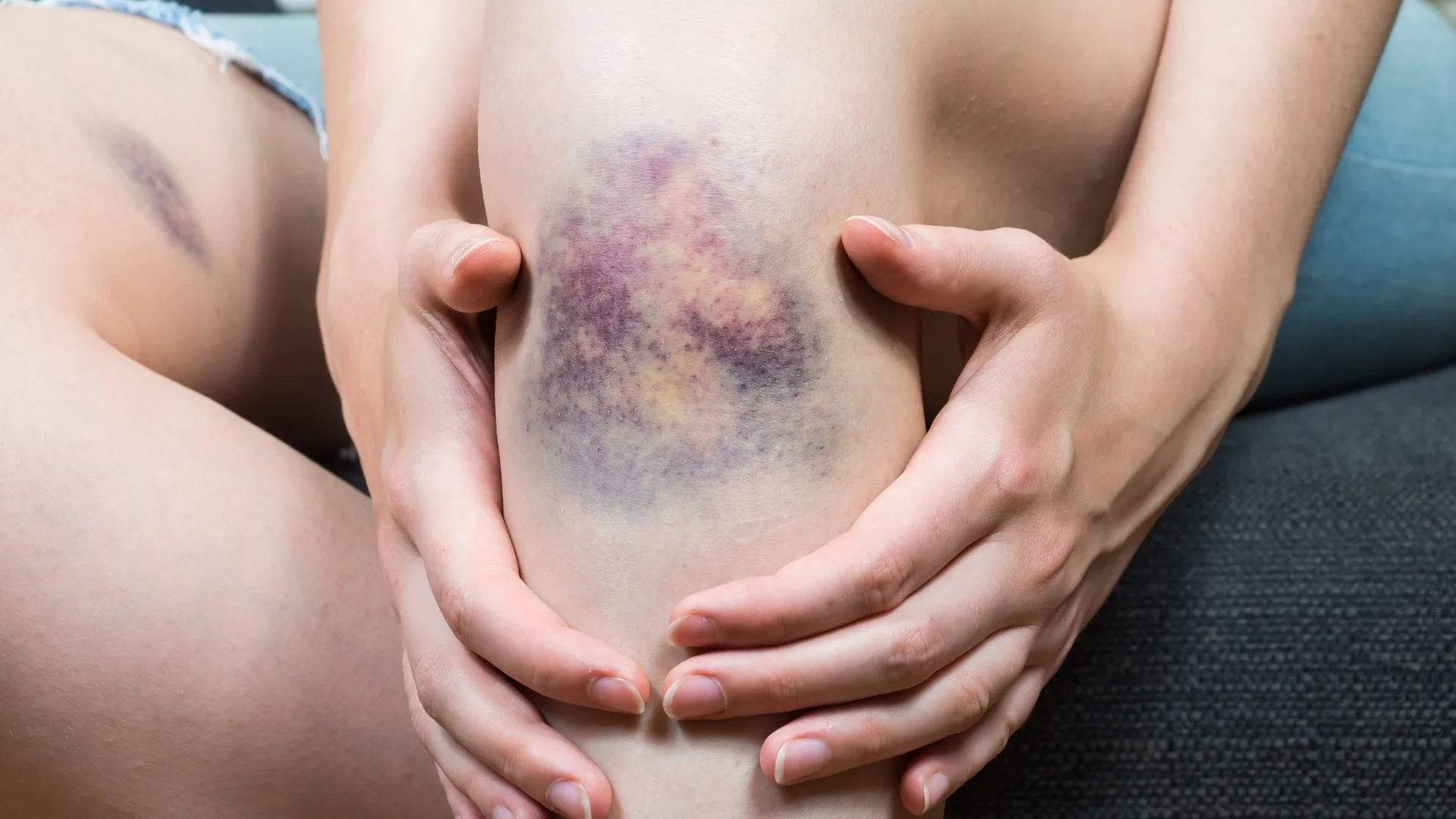 Is It a Bruise or Something More Serious