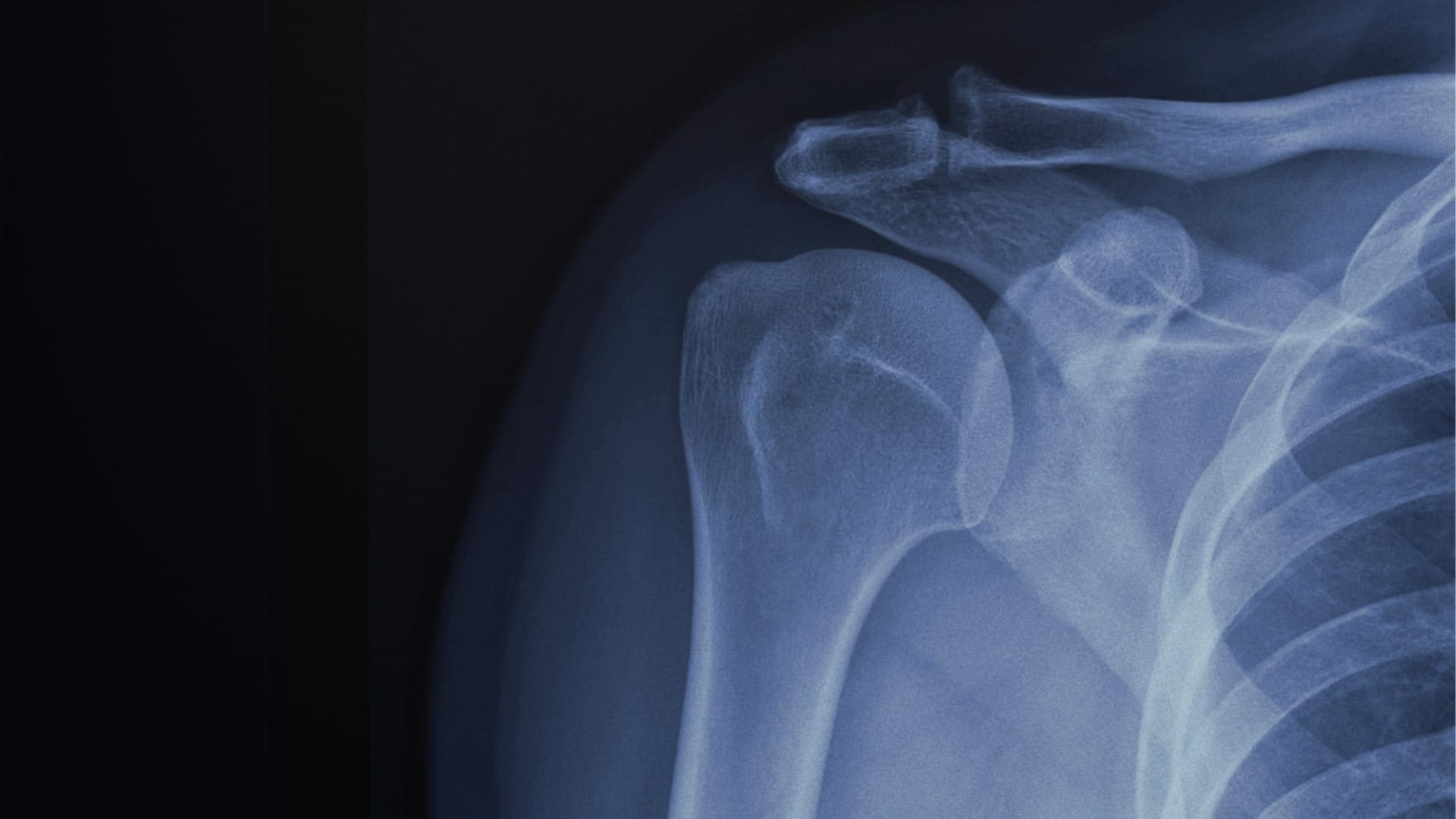 What Is Shoulder Calcification